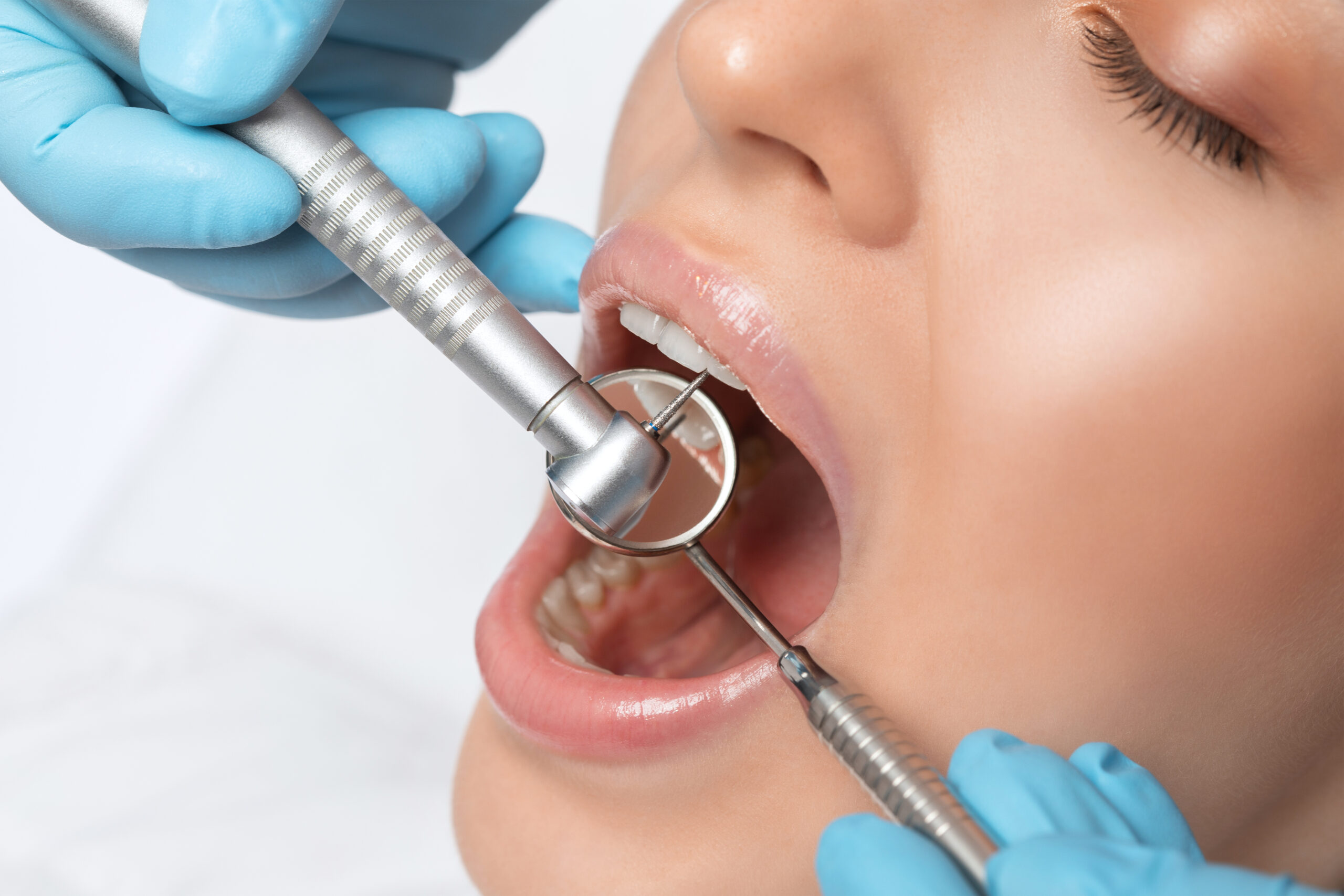 A dentist doctor treats caries on a tooth of a young beautiful woman in a dental clinic. Tooth filling.