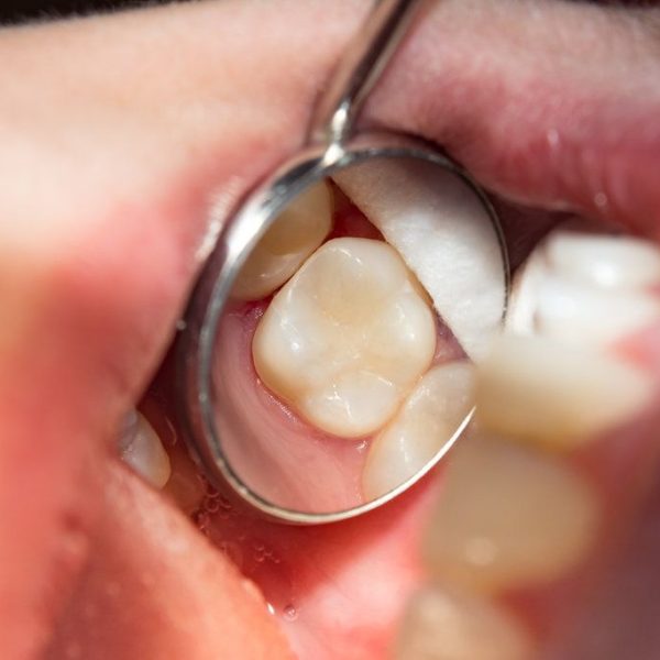 Dental examination of a molar