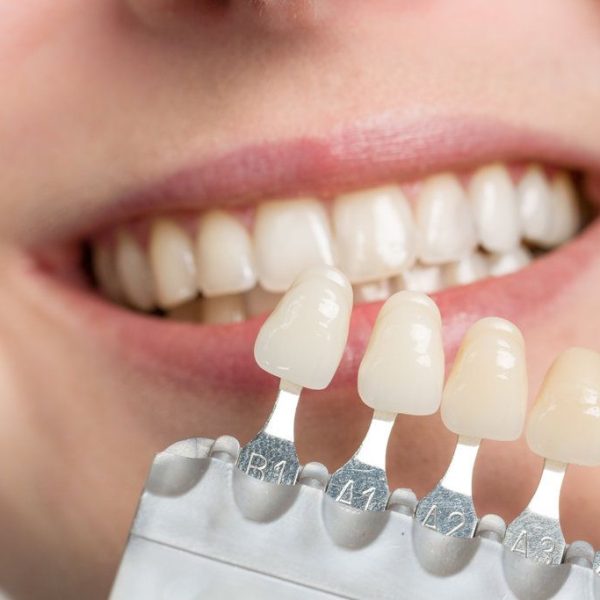 Smiling person comparing tooth shades
