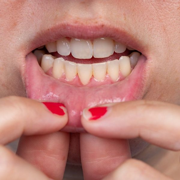 Person showing gums and teeth.