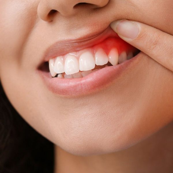 Person showing inflamed gum condition